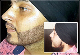 Facial Hair Transplant