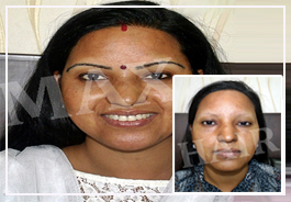 Women hair Transplant Result